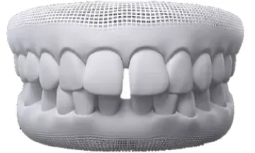 Diastema