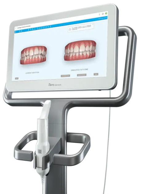 Scanner intraoral iTero para planejamento digital Invisalign